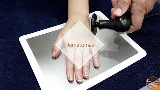 Diatermia en Tratamientos Esteticos y Dermatofuncionales [upl. by Aliuqat]