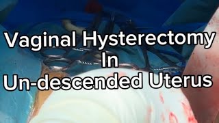 Vaginal Hysterectomy in Undescended uterus  Very important  Tips and Tricks  to make it Easy ⭐️⭐️ [upl. by Iruam]