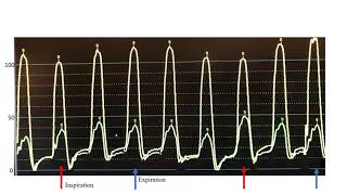 Hemodynamics Constrictive pericarditis cases mechanisms technical tips Elias Hanna Univ of Iowa [upl. by Nylrem547]