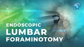 What is Endoscopic Lumbar Foraminotomy [upl. by Ohploda]