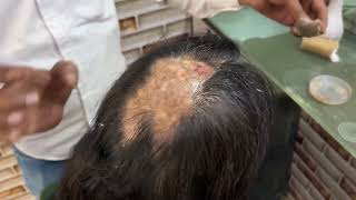 Alopecia treatment alopecia treatment medicine alopeciaareata viralvideo shorts trending [upl. by Ulberto]