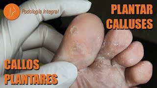 Plantar calluses Podología Integral podologiaintegral [upl. by Dyane]