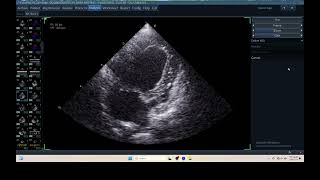 IQ 306 AFI RV ECHOPAC ANALYSIS HEPATOMA PTE ECHOCARDIOGRAPHY [upl. by Fabria]