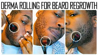 Microneedling for Beard Growth  30 Day Results [upl. by Anilas]