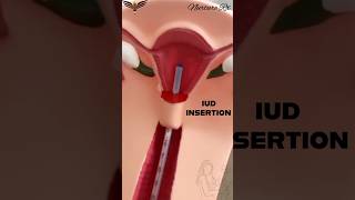 IUD insertion precautions pregancy nclex nurses nursing iud uterus child birth control [upl. by Molly673]