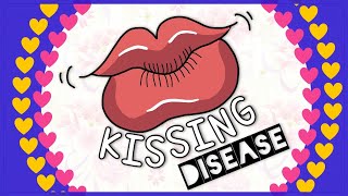 Infectious mononucleosis Kissing disease Diagnosis Clinical feature Treatment [upl. by Nolham756]