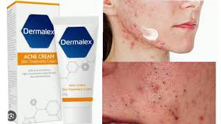 Dermalex Acne Treatment Cream [upl. by Hgielrak]