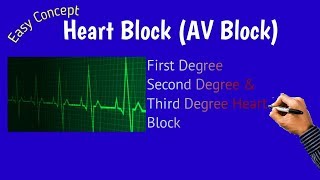 Heart Block  AV block Atrioventricular Block [upl. by Westfall547]