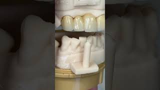 Esthetic zirconia bridge EnvisiontecMain envisiontec [upl. by Luap]