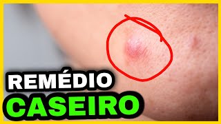 Espinhas inflamadas o que fazer para acabar Remédio caseiro passo a passo [upl. by Llevad568]