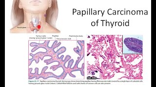 Pathology 818 a Papillary Carcinoma Thyroid Orphan Annie Eye Ground Lateral Aberrant psammoma bodies [upl. by Metzgar439]