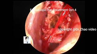 Ear wax removal One cholesteatoma case patient of pale [upl. by Loise985]