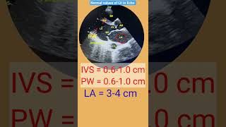 Normal values of IVS LA LV size in Echo l echo shorts [upl. by Ylerebmik901]