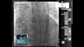 TAVI Corevalve quotValve in Valvequot de Medtronic [upl. by Ys]