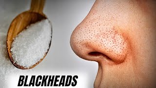 How to Remove Acne Blackheads from Your Face Naturally [upl. by Acebber889]