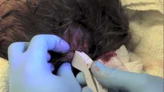 scalp laceration fixed with staples [upl. by Asor815]