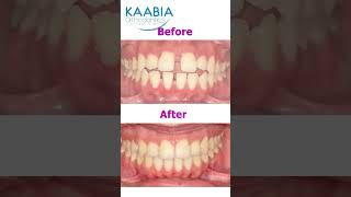 Bimaxillary protrusion  open bite and diastema [upl. by Perseus]