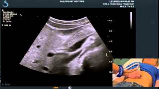 Hot Tips  Locating the Common Bile Duct with Ultrasound [upl. by Milone]