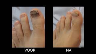 Podotherapie InKa herplaatsen nagelbeugel orthonyxie [upl. by Karry347]