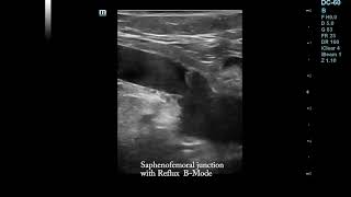 Saphenofemoral junction without and with reflux Duplex Ultrasound [upl. by Elitnahc364]