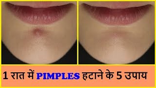 पिम्पल हटाने के 5 उपाय  HOW TO REMOVE PIMPLES OVERNIGHT  Home remedies for Pimples  Acne [upl. by Lally873]