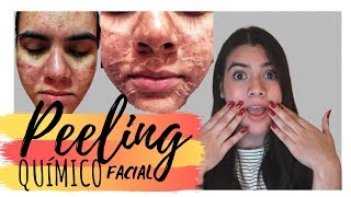 MI EXPERIENCIA PEELING QUÍMICO FACIAL l ACNÉ l PROCESO  ROCIO LUNA [upl. by Benedetto]