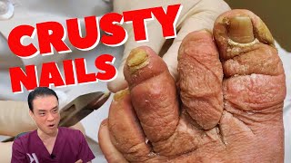 SUPER CRUSTY Nail Cutting on BOTH FEET  Dr Kim Kim Foot and Ankle [upl. by Eastman]