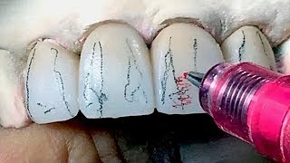 Tooth Morphology Design Techniques for Dental Lab Technicians [upl. by Allerie]