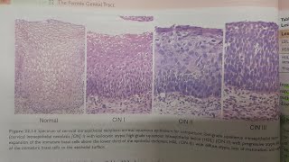 Cervical Intraepithelial Neoplasia  SPECIAL PATHOLOGY [upl. by Haeli481]