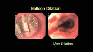 quotPrevention of Esophageal Stricture After Endoscopicquot [upl. by Fesuy]