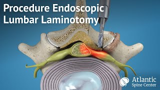 Procedure Endoscopic Lumbar Laminotomy [upl. by Anaitak502]