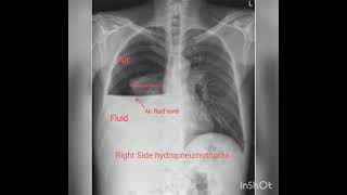 Chest X rays Part 2  Pleural effusion Hydropneumothorax Pneumothorax [upl. by Aksel]