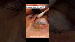 Contact Lenses Under Eyelid PAINFUL oddlysatisfying sick blackhead pimplepopper satisfying WOW [upl. by Adlesirk]