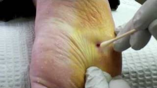 Surgical Plantar Wart Removal [upl. by Godfry]