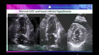 Normal LVEF and reduced GLS in a patient with triple vessel CAD [upl. by Mendelsohn]