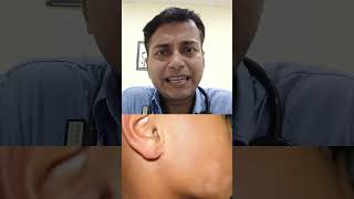 Pityriasis Alba For Consultation please call on 7400124238 shortvideo motivation [upl. by Martainn]