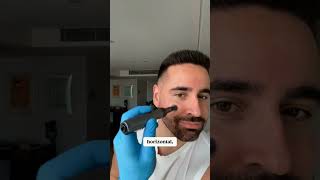 Microneedling with the M8s [upl. by Janine]