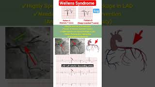 Wellens Syndrome l Type A Type B ecg heartattack ecg shorts [upl. by Leavitt655]