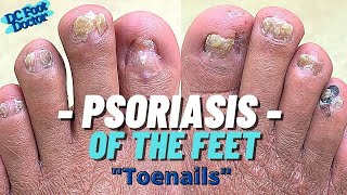 Psoriasis and the Feet Part 1 Trimming Psoriatic Nails [upl. by Analart]