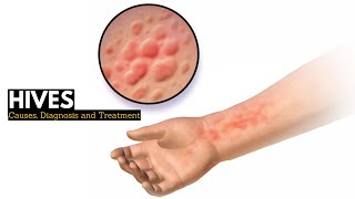 HIVES Causes Signs and Symptoms Diagnosis and Treatment [upl. by Atiekan4]