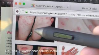 What Is Hand Foot Mouth Disease And How To Help Your Child [upl. by Granthem674]