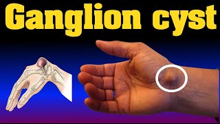 ganglion cyst [upl. by Hilde]