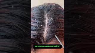 Dermatite seborreica beleza tricologia terapiacapilarintegrativa cabelo clinicacapikar [upl. by Yulma]