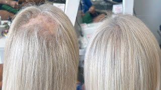 Vlight hair extensions alopecia  hair thinning hair extensions transformation [upl. by Heinrich479]