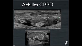 Achilles CPPD [upl. by Eirot]