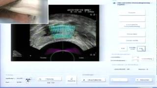 LiveOpHIFU bei Prostatakrebs T Egner [upl. by Orr]