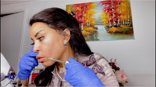 INJECTION LEVRES contour avec canule [upl. by Agosto]