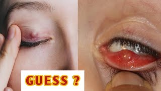 Stye or chalazion  explained indetail eyecareoptom eyelid infection lidproblems [upl. by Alin]