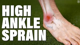 High Ankle Sprain  Syndesmosis Injury Evaluation  Education  Exercises [upl. by Paske]