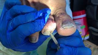 Medical nail care by professional foot care Registered Nurse [upl. by Eibbil668]